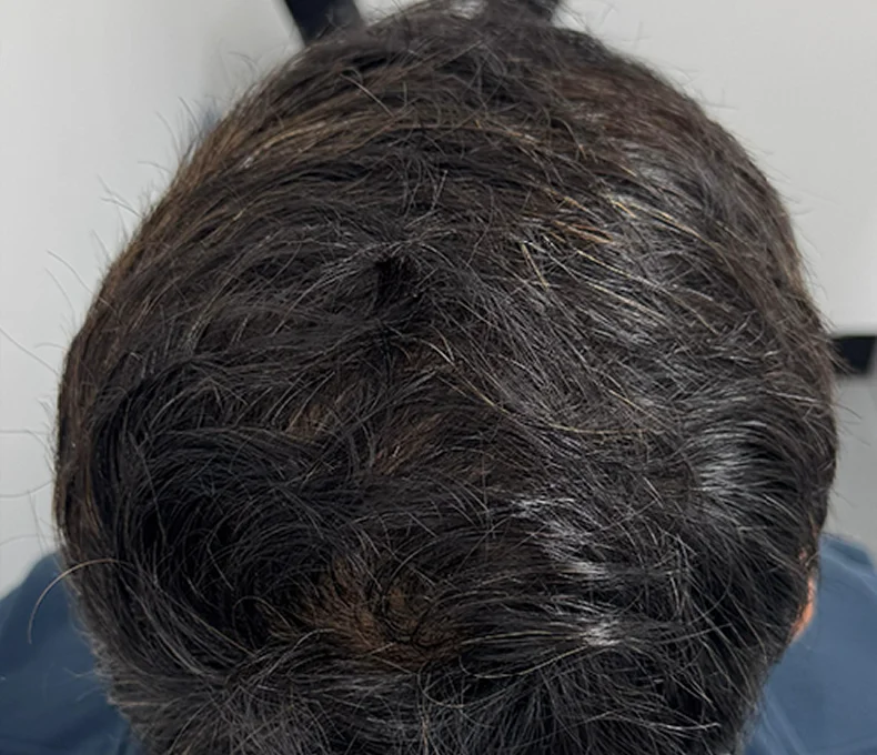 After Nueroot hair treatment