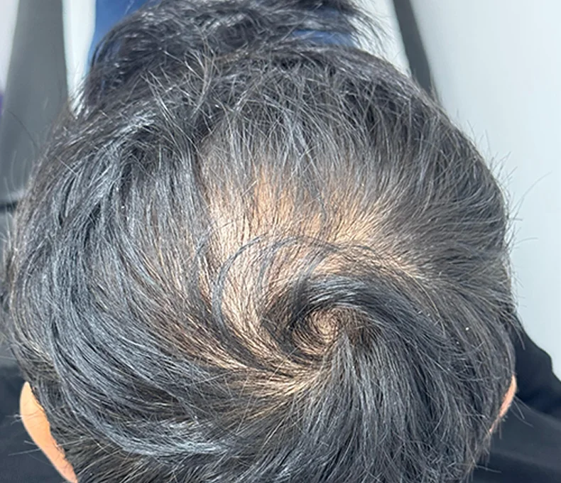 Before Nueroot hair treatment